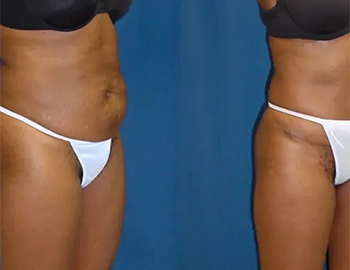 Tummy Tuck Abdominoplasty at Refine Skin and Body Clinic.