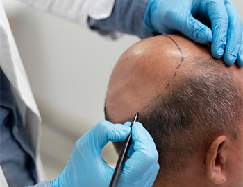 Alopecia Areata Treatment at Refine Skin and Body Clinic.