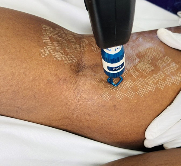 Stretch Marks Treatment at Refine Skin and Body Clinic.